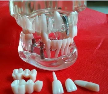 Стоматологическая модель патологии зуба Съемные стоматологические материалы Бесплатная доставка